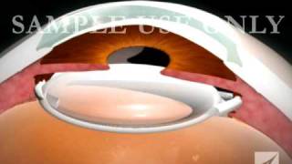 Eye Surgery- Cataract with Lens Replacement
