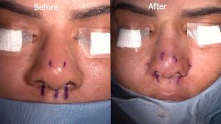 Alar Wedge Resection-19: Rhinoplasty Bizrah- London/ Dubai- Dr. Bashar Bizrah