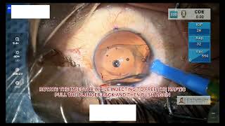 AIOCMT3 2024 - VT89 - Dr.Tambe Shruti Bharat - Surgical pearls for beginners in Phakic IOL surgery