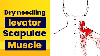 Dry needling levator Scapulae