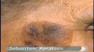 Common Skin Lesions