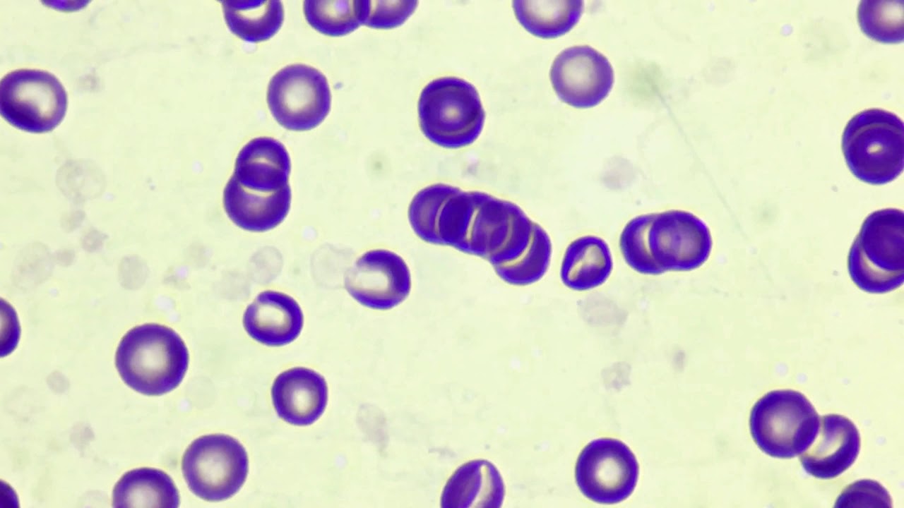 Rouleaux Formation In Blood Smear - YouTube