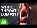 Why Do I Have Tonsil Stones? Why Do I Have Tonsil Stones?