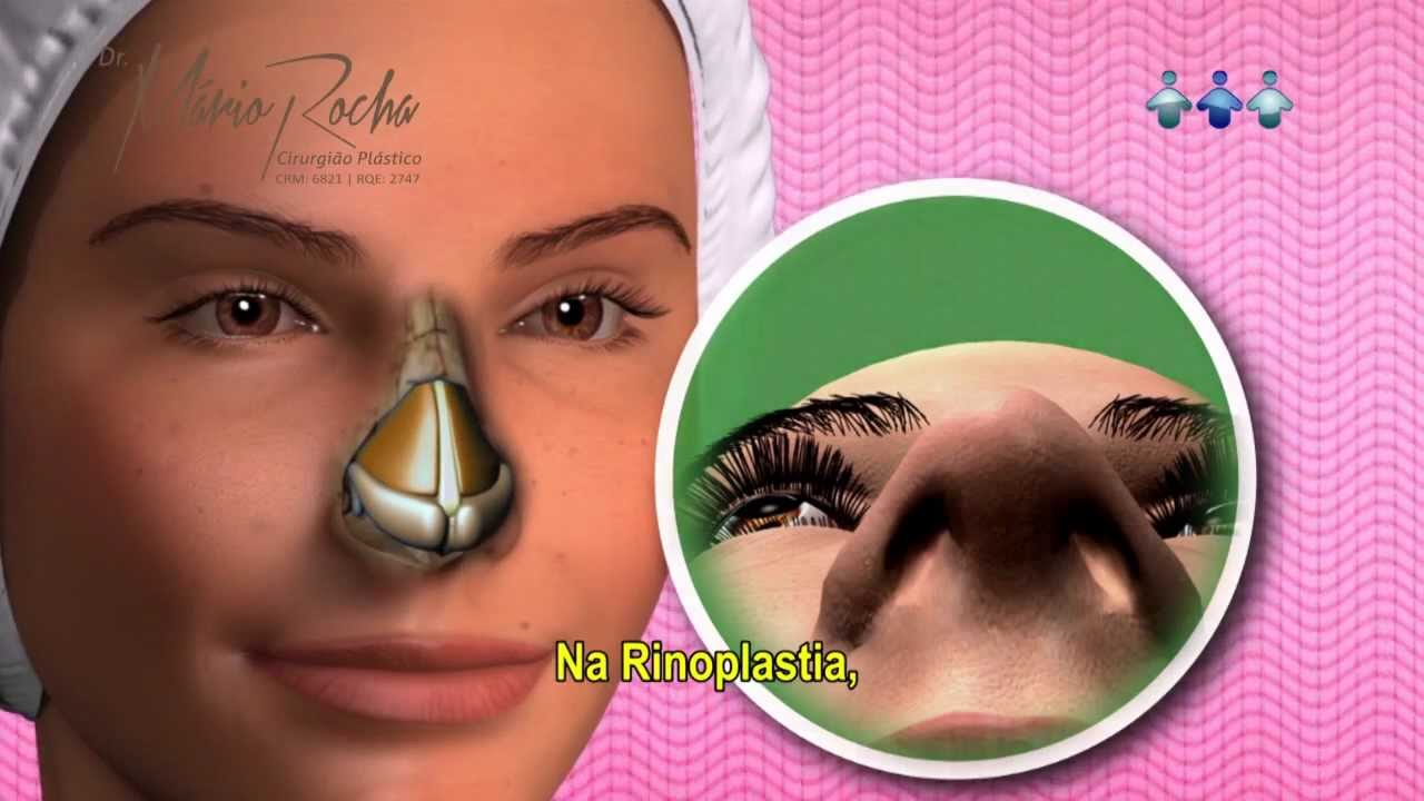 Rinoplastia - Cirurgia Plástica Do Nariz - YouTube