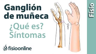 Ganglión de muñeca o muñeca abierta - Qué es, causas, síntomas y tratamiento