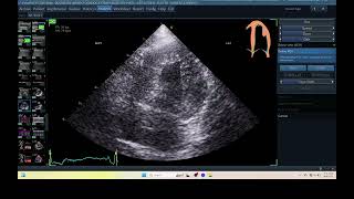 IQ  345 AUTOEF ECHOPAC ANALYSIS ECHOCARDIOGRAPHY