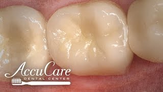 AccuCare Dental Centers—Scottsdale, Arizona—Sealants