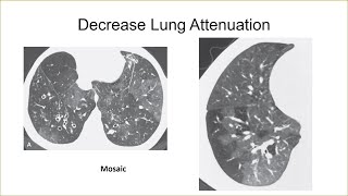 Basic Thoracic CT 2021 part7