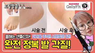 발각질 완전 정복!! 발에 만년설이 있다구요?_드릴 말씀09편