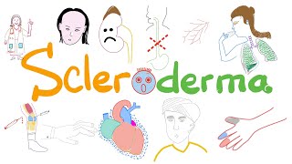 Scleroderma (Systemic Sclerosis) - Signs, Symptoms, Pathophysiology - Rheumatology