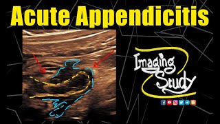 Acute Appendicitis || Ultrasound || Case 292