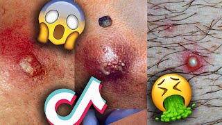 Pimple Blackheads Cysts Popping Videos TikTok Compilation Part 15