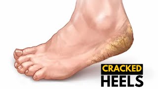 Foot Health Matters: Unraveling the Mystery of Cracked Heels