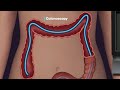 Mayo Clinic Minute - Who should be screened for colorectal cancer?