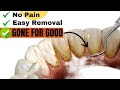 4 Secrets to Never have dental plaque again (Hint its all natural)