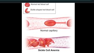 Sickle cell anemia Dr g medical examiner