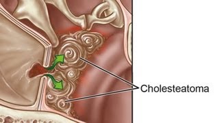 How to Treat an Ear Cyst | Ear Problems