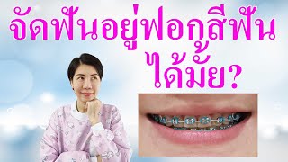 จัดฟันอยู่ฟอกสีฟันได้มั้ย