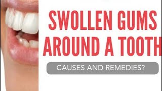 Swollen gums around a tooth    ماسخورے کا شافی علاج ممکن ہے