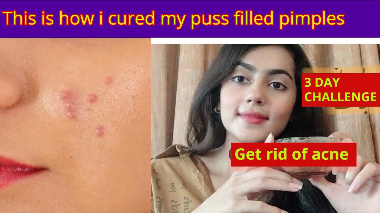 Home Remedy To Cure Puss Filled Pimples | Get Rid Of Acne | Get Rid Of ...