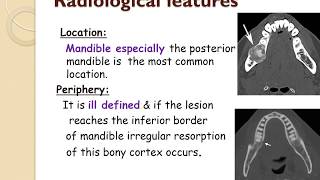 OSTEORADIONECROSIS AND IT'S MANAGEMENT