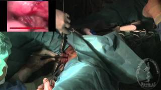 Transvaginal Nephrectomy - Vaginal incision closure