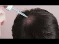 జుట్టు బాగా రాలిపోతుందా... how to prevent excess hair fall and promote hair regrowth