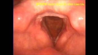 聲帶潰瘍 vocal ulcers Dr. Ken-Liao Liu