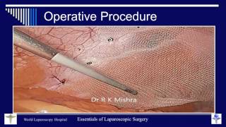 Dr R K Mishra's Lecture on Laparoscopic Repair of Ventral Hernia