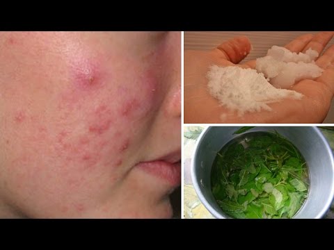 7 Cystic Acne Home Remedies that Really Work 7 Cystic Acne Home Remedies that Really Work