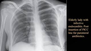 Elderly lady with infective endocarditis  Post insertion of PICC line for parenteral antibiotics