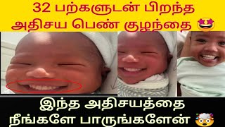 😲 32 பற்களுடன் பிறந்த அதிசய பெண் குழந்தை | Latest news in tamil | IB