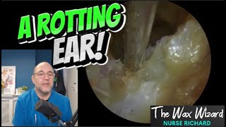 A ROTTING EAR! 411 #ear #earwax #earwaxremoval #asmr #satisfying #foryou #fyp #foryourpage