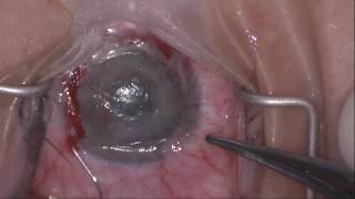 Fine Needle Diathermy Occlusion of Corneal Vessels with Adjunct Anti-VEGF Injections