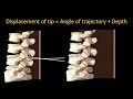 successful spinal anesthesia = skillful needle handling