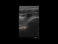 Posterior Shoulder Dislocation – Ultrasound Image Interpretation