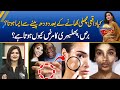 Pityriasis versicolor (Phulbehri) - Symptoms, Causes and Treatment | Morning With Fiza