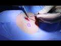 surgical lipoma removal see the treatment