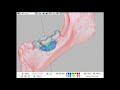 3d pdf tutorial – maxgraft® bonebuilder design how to measure the block design