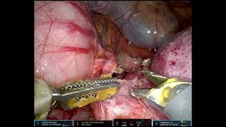 Jaboulay Pyloroplasty (Long)