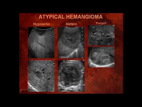 Sonography Of Liver Masses Youtube