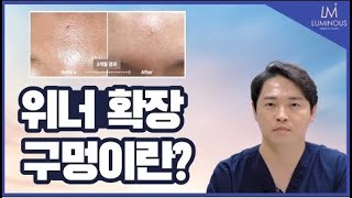 얼굴 왕모공, 위너확장구멍?이라면 다른치료는 안되욧!!