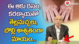 White Patches | ఈ ఆకు రసం, కరక్కాయతో తెల్లమచ్చలు మాయం.. Dr. Ch Madhusudana Sarma | TeluguOne Health