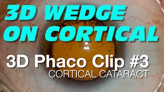 3D Phaco Clip #3 - Cortical Cataract