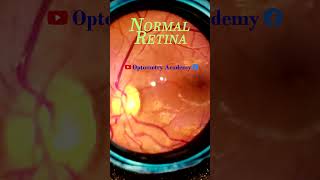 Normal Retina Smartphone Fundus Videography | Fundus Photography | Short Video 57