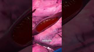 How A Brain Aneurysm Happens