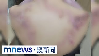 妙齡女背部隆起「巨蟲級」蟹足腫　國外學者都嚇到｜#鏡新聞