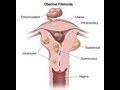 Uterine Fibroids Types and Treatments : Intramural, Submucosal and Subserosal Fibroid.