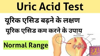 Uric Acid Test in Hindi | uric acid treatment |  uric acid symptoms