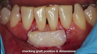 Connective Tissue Graft Tunneling Technique